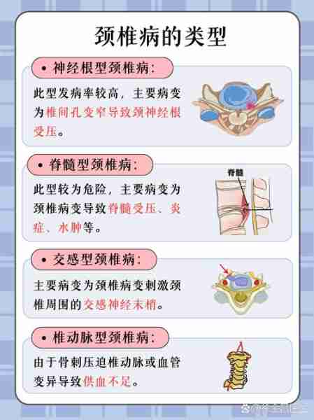 颈椎病预防方法/颈椎病预防办法